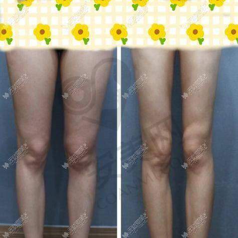 与其他医院相比，长沙雅美医院的腰腹 + 大腿吸脂有什么不同？
