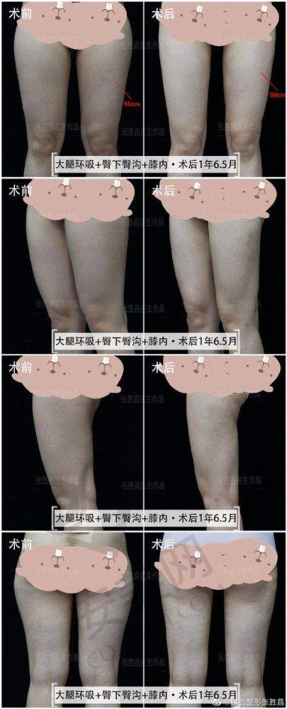 长沙雅美医院腰腹 + 大腿吸脂的价格是如何构成的？