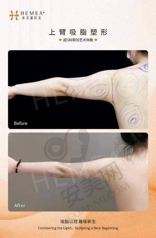 成都怡脂手臂吸脂的成效怎么样？