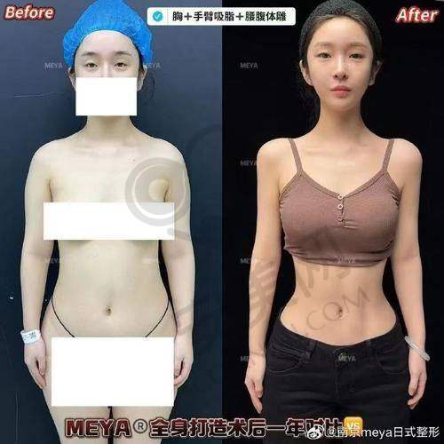 成都怡脂手臂吸脂项目有什么特色技术？