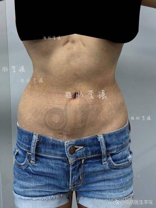 北京嘉禾整形医院腰腹吸脂有哪些优势？