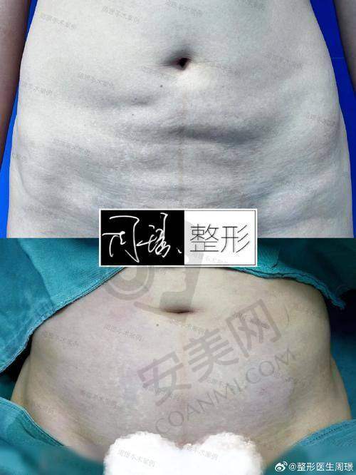 北京嘉禾整形医院腰腹吸脂价格为何是16000元起？