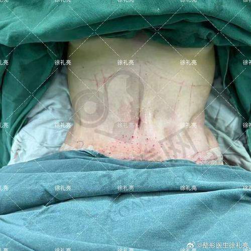 北京嘉禾整形医院腰腹吸脂安心吗？