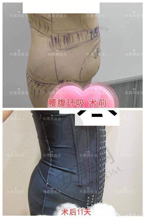 哪些人适合北京嘉禾整形医院腰腹吸脂？