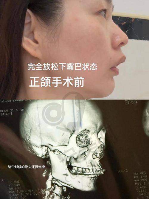 上海正颌手术医院排名榜公示