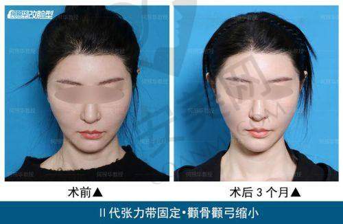 重庆松山医院磨颧骨手术价格为何38000元起？