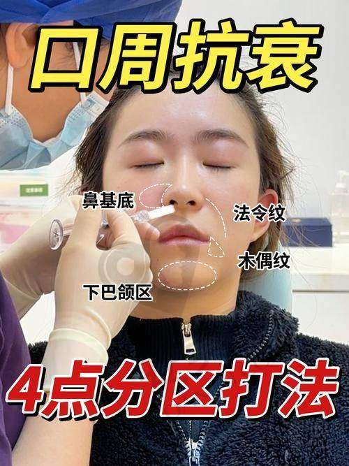 济南丽合玻尿酸填充法令纹有副作用吗？