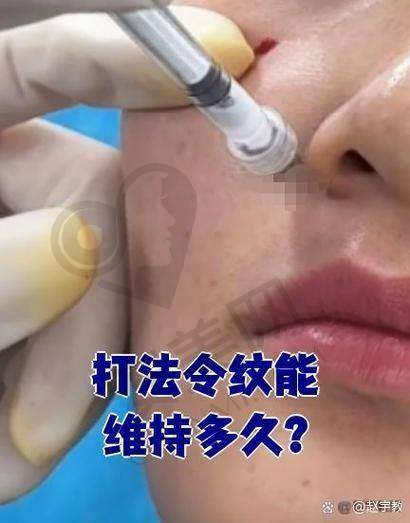 湘西吉首星美医院玻尿酸去法令纹的优势有哪些？