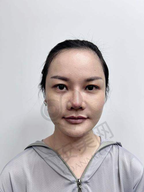 为什么选择湘西吉首星美医院进行玻尿酸去法令纹治疗？