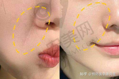 玻尿酸去法令纹有哪些注意事项？