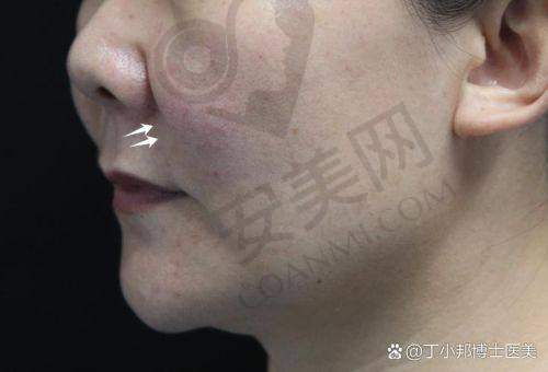 济南丽合玻尿酸填充法令纹成效如何？