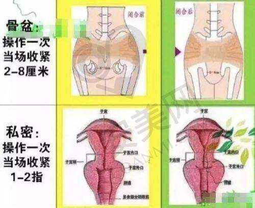 3D生物束带紧缩术适合哪些人群？
