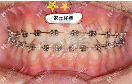 无锡维乐口腔金属托槽矫正价格为何如此吸引人？