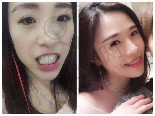 宜昌爱合口腔正雅隐形矫正适合哪些人群？