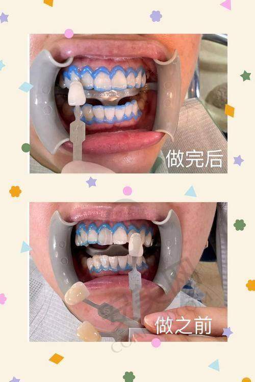 南京美奥口腔牙齿贴面美白技术有什么特色？