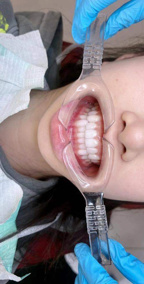 什么是牙齿贴面美白？