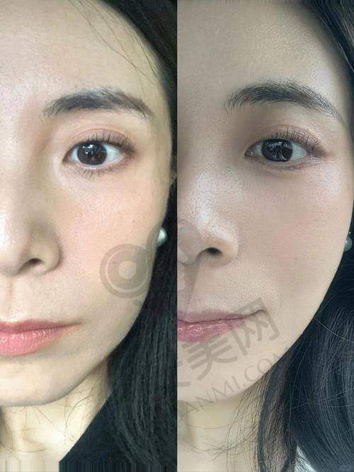 北京丽合热玛吉抗衰和其他抗衰方法相比有什么特色？