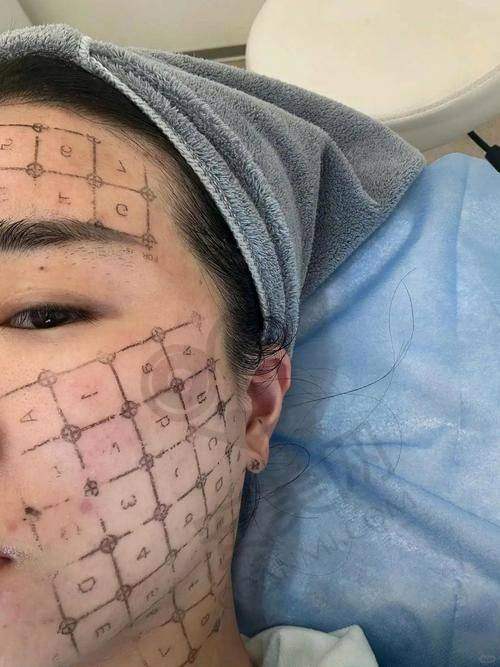 北京丽合热玛吉抗衰值得尝试吗？
