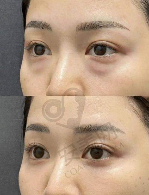 重庆米格祛眼袋手术过程是怎样的？