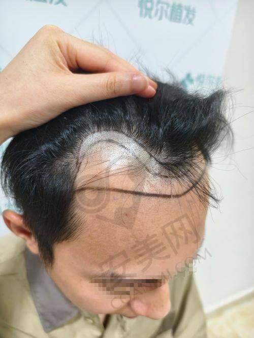 南京新生植发医院价格表