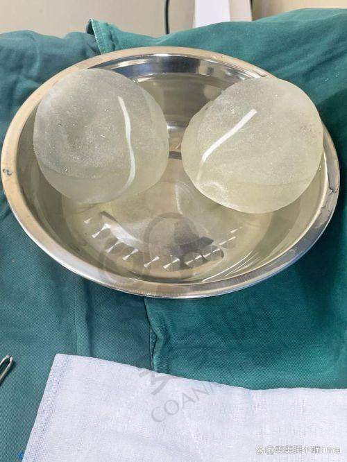 术后感受和注意事项有哪些？