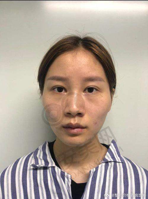 在重庆松山整形医院做磨骨手术，除了价格还需要考虑什么？