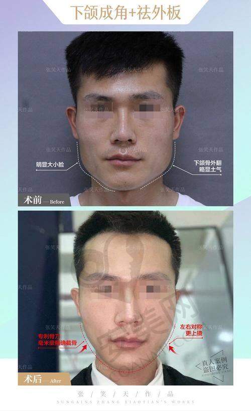 重庆松山整形医院磨骨手术价格受哪些因素影响？
