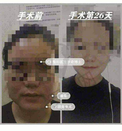 如何在重庆松山整形医院获取正确的磨骨价格？