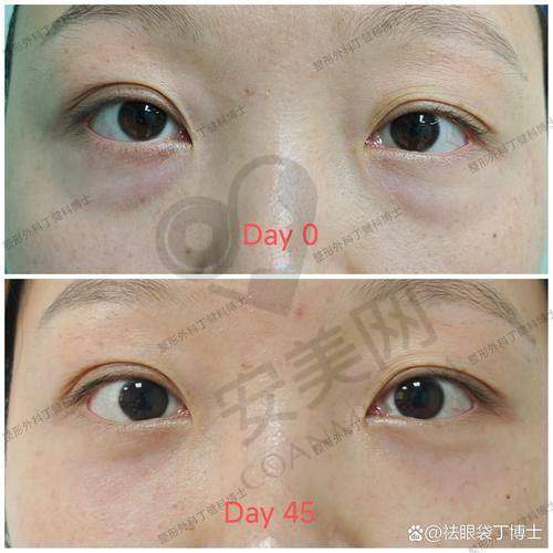 重庆米格祛眼袋的成效能维持多久？