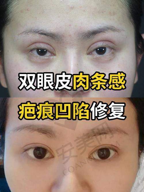 吕方中医生：双眼皮修复领域的佼佼者