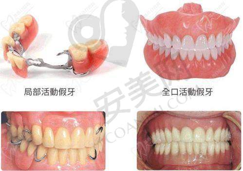 全口假牙的制作过程复杂吗？