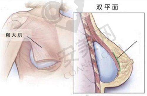 西安西美医院激光溶脂后需要注意什么？