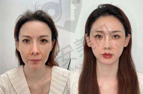 上海华美面部提升的服务质量如何？