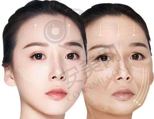 上海华美面部提升的成效能维持多久？
