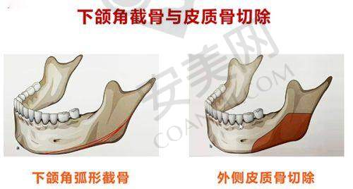 重庆松山医院轮廓磨骨整形的价格合理吗？