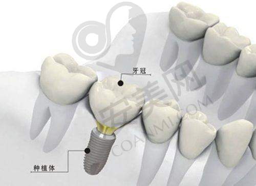 上饶牙博仕口腔种植牙有哪些优势？
