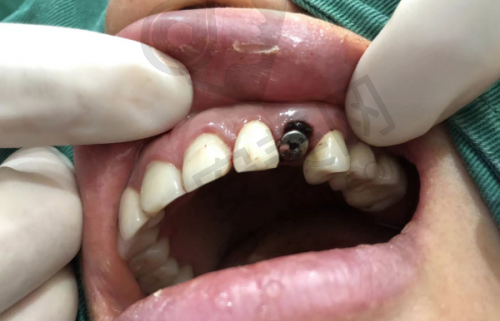株洲美天笑口腔文树生院长种植牙怎么样？