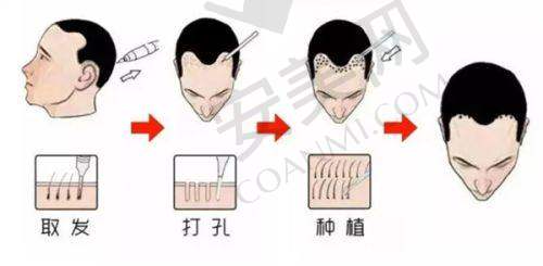 广州崇爱植发医院的收费情况
