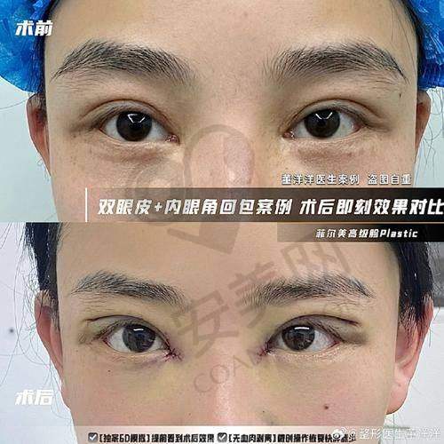 上海华美医院的双眼皮修复与其他医院相比有什么不同？