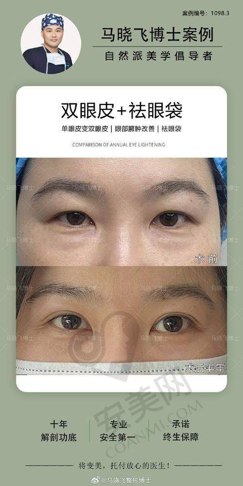 刘志刚院长的手术风格是怎样的？