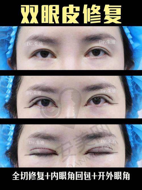 为什么双眼皮需要修复？