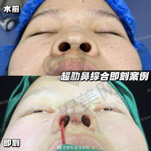 大连星妍8c骨雕鼻适合哪些人群？