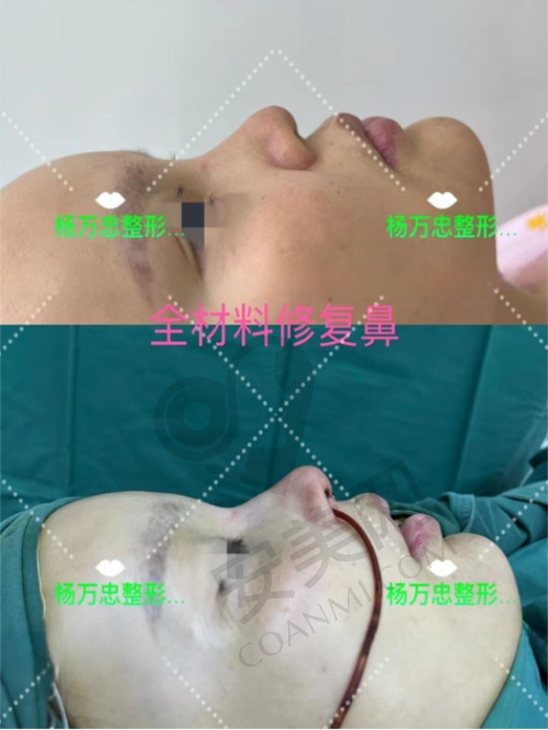大连星妍8c骨雕鼻术后需要注意什么？