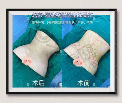 曹卫刚医生抽脂技术怎么样？费用是多少？