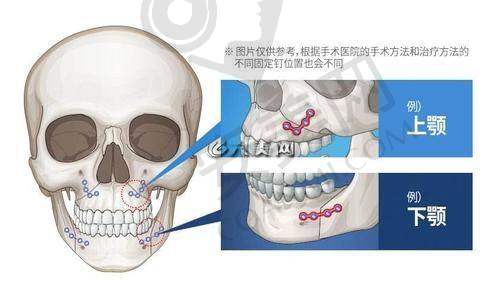 上海首尔丽格双鄂手术的成效如何保护？