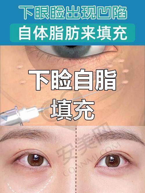 选择北京禾美嘉进行吸脂和脂肪填充有哪些保护？