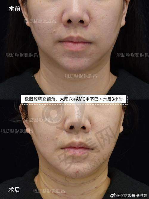 北京禾美嘉为何被称为脂肪专科医院？