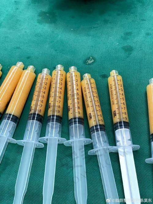 北京禾美嘉的吸脂和脂肪填充价格是否合理？