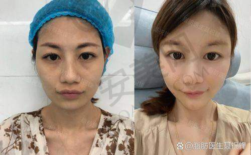 北京禾美嘉在吸脂和脂肪填充方面有哪些成功实例？