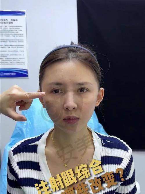 深圳富华注射玻尿酸价格与医生技术有关吗？